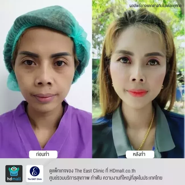 รีวิว ฉีดไขมันหน้า ที่ The East Clinic