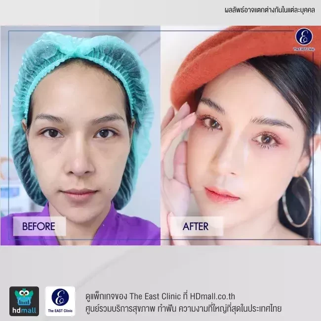 รีวิว ฉีดไขมันหน้า ที่ The East Clinic