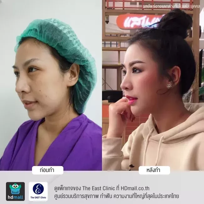 รีวิว ฉีดไขมันหน้า ที่ The East Clinic