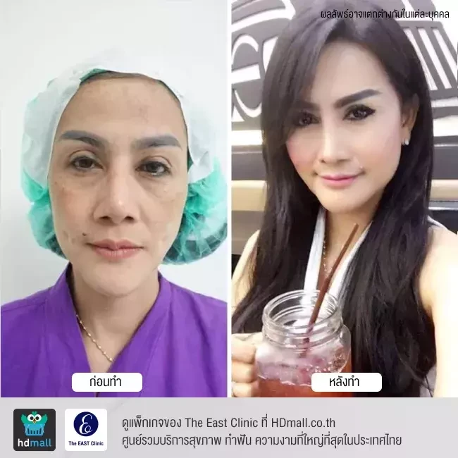 รีวิว ฉีดไขมันหน้า ที่ The East Clinic