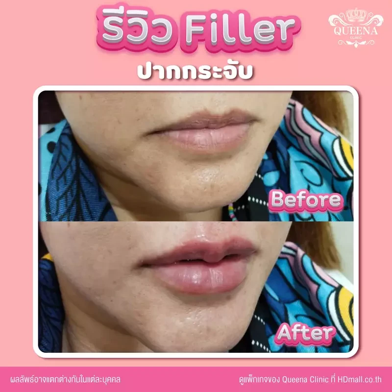 รีวิว ฉีดฟิลเลอร์ ที่ Queena Clinic