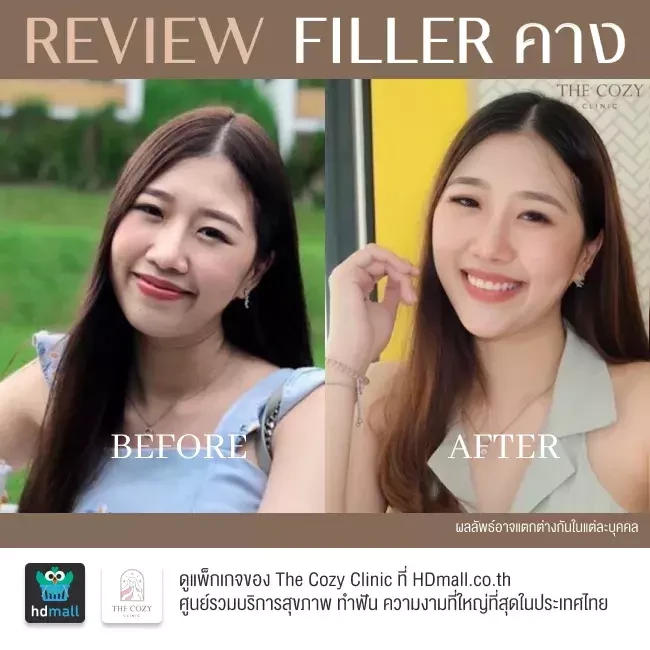 รีวิว ฉีดฟิลเลอร์ ที่ The Cozy Clinic