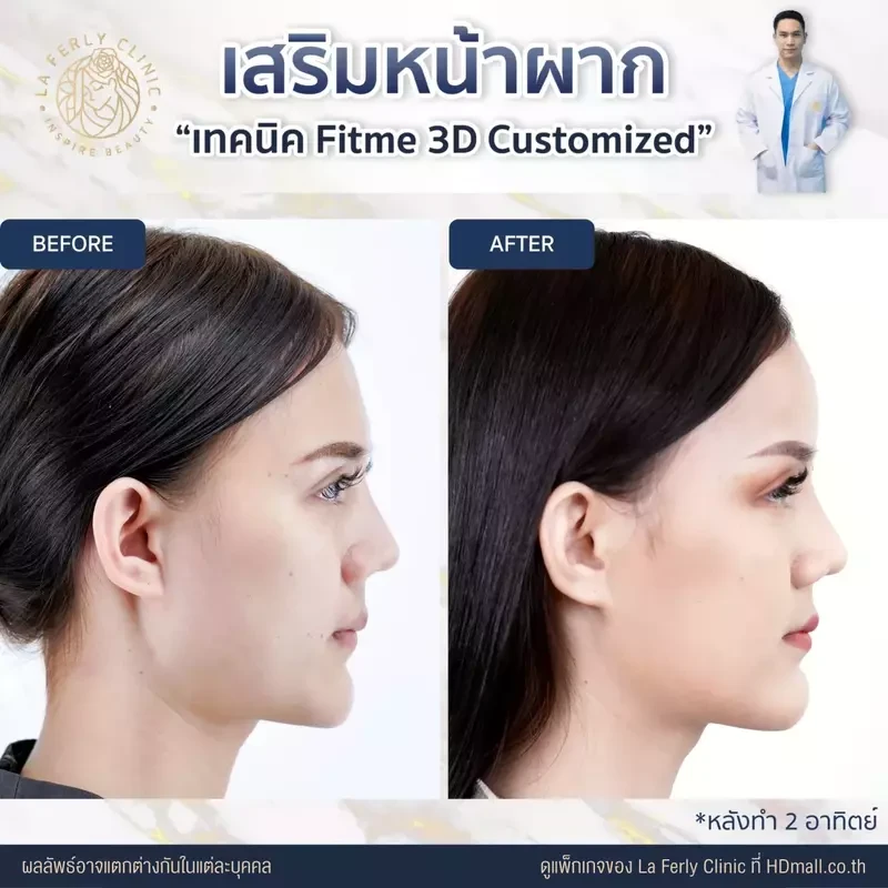 รีวิว เสริมหน้าผาก ที่ La Ferly Clinic