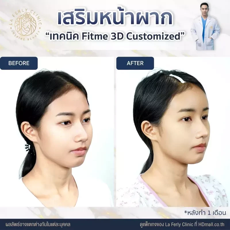 รีวิว เสริมหน้าผาก ที่ La Ferly Clinic