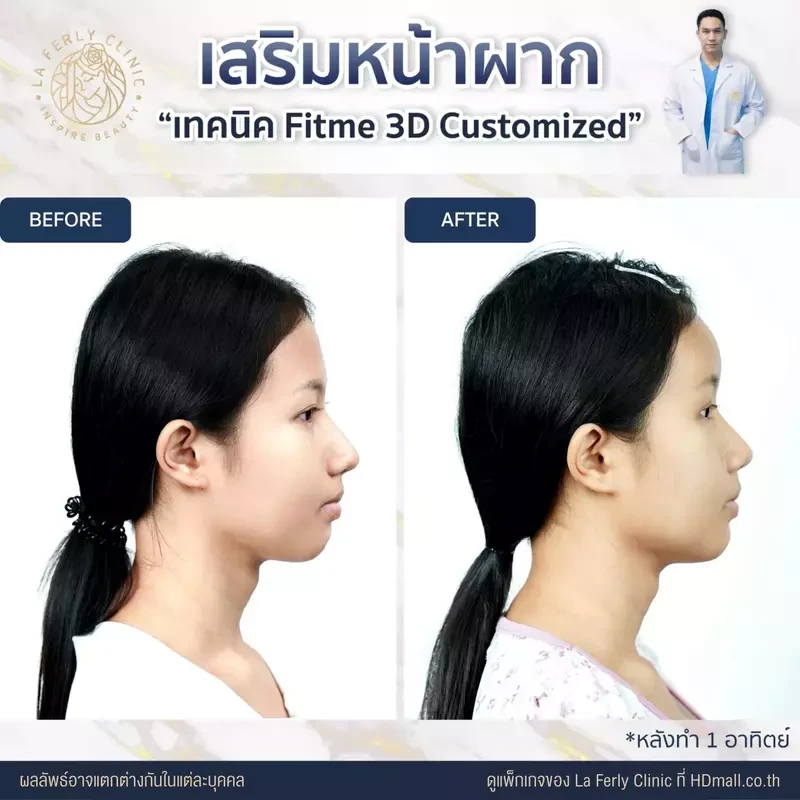 รีวิว เสริมหน้าผาก ที่ La Ferly Clinic