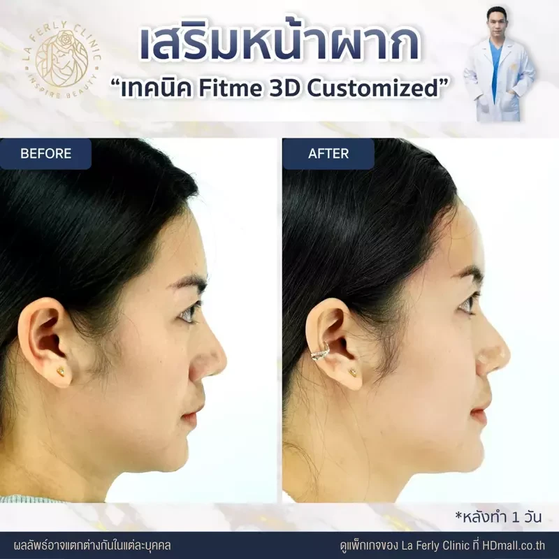 รีวิว เสริมหน้าผาก ที่ La Ferly Clinic