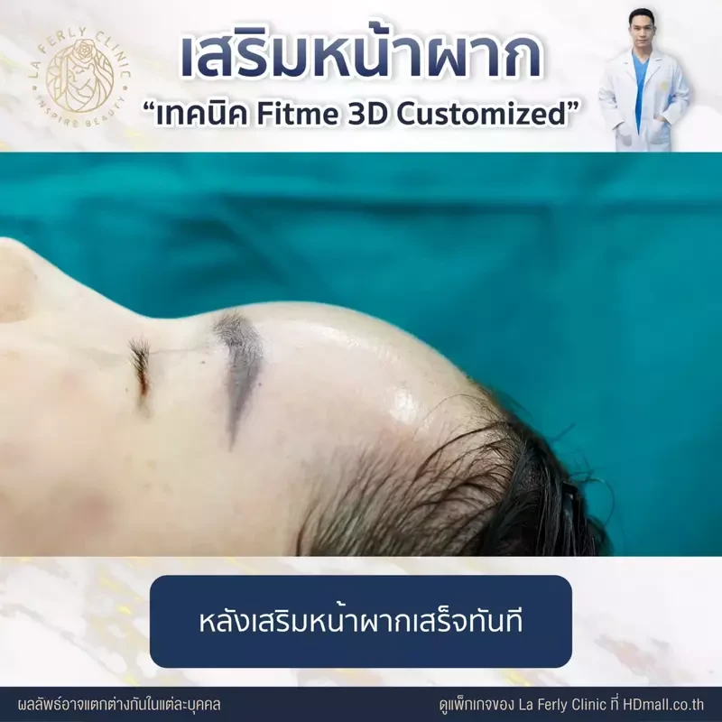 รีวิว เสริมหน้าผาก ที่ La Ferly Clinic