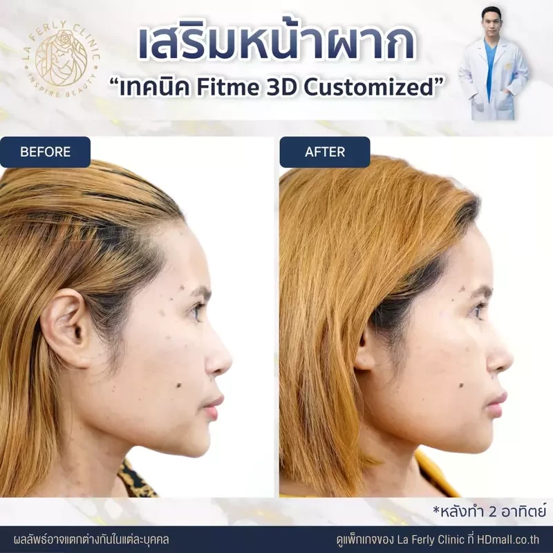 รีวิว เสริมหน้าผาก ที่ La Ferly Clinic