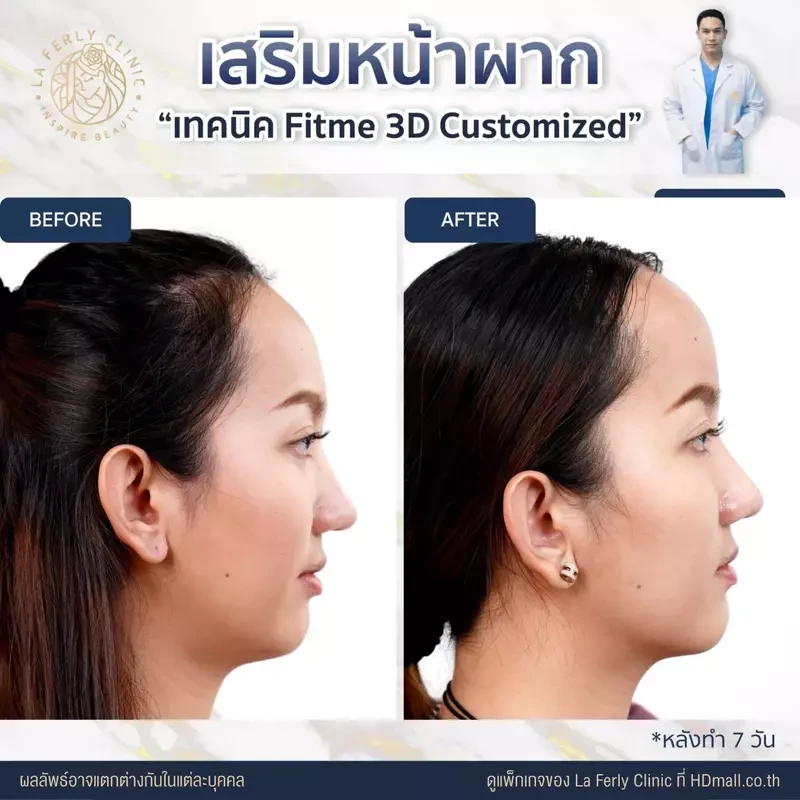 รีวิว เสริมหน้าผาก ที่ La Ferly Clinic