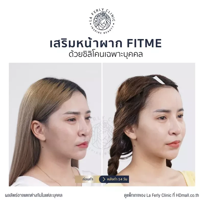 รีวิว เสริมหน้าผาก ที่ La Ferly Clinic