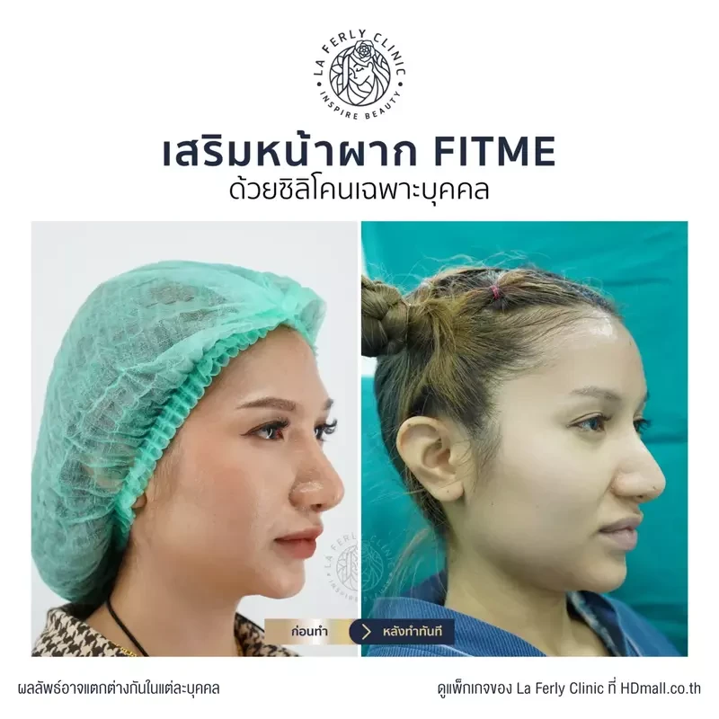 รีวิว เสริมหน้าผาก ที่ La Ferly Clinic
