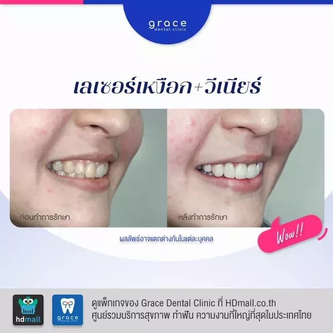 รีวิว ตัดเหงือก ที่ Grace Dental Clinic