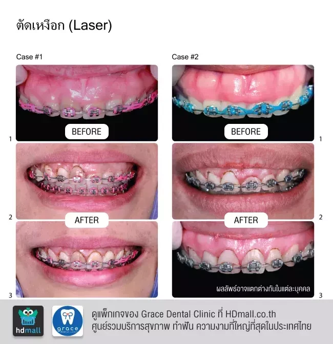 รีวิว ตัดเหงือก ที่ Grace Dental Clinic