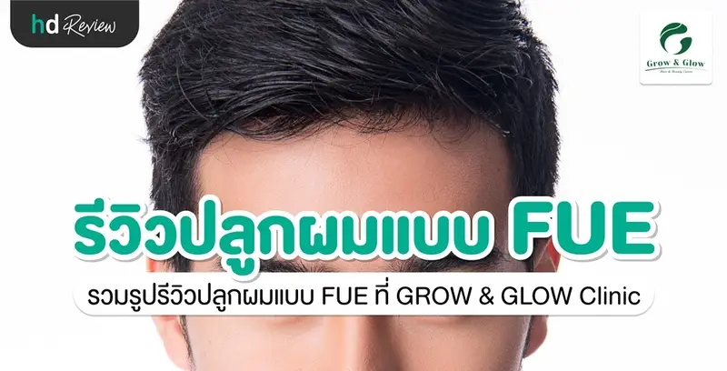 รีวิวปลูกผมแบบ FUE ที่ GROW & GLOW Clinic