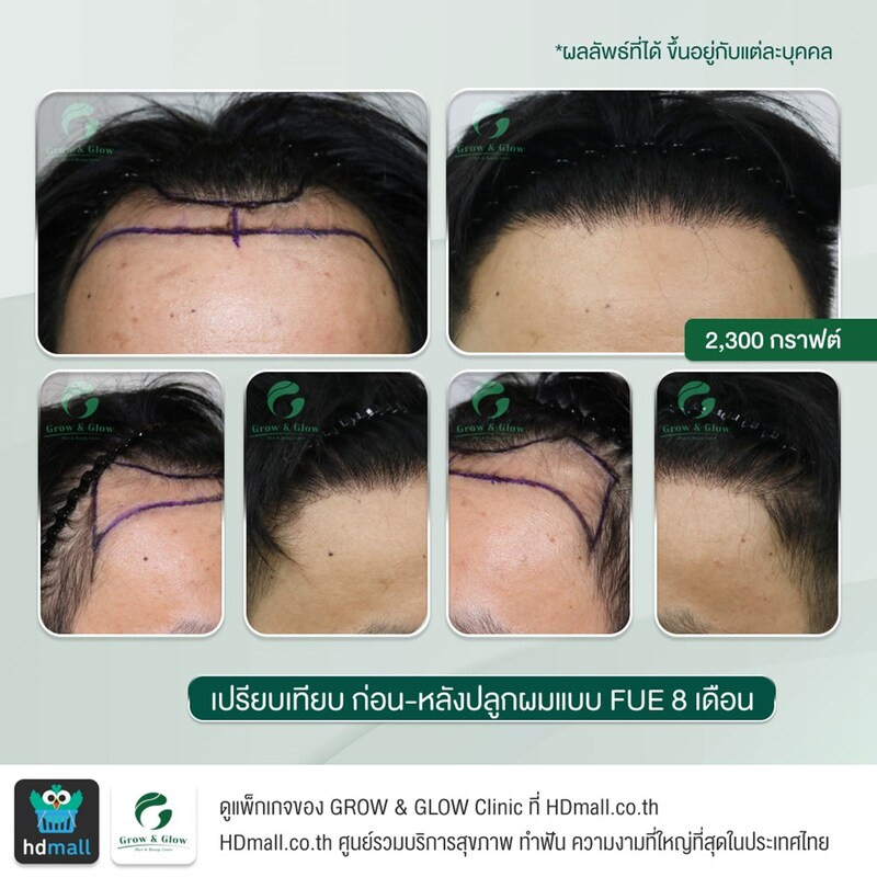รวมรูปรีวิว ปลูกผม FUE ที่ GROW & GLOW Clinic