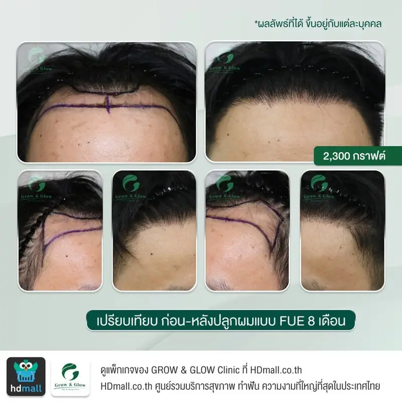 รวมรูปรีวิว ปลูกผม FUE ที่ GROW & GLOW Clinic
