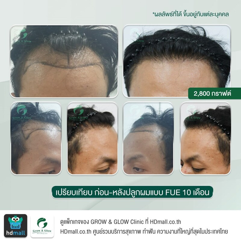 รวมรูปรีวิว ปลูกผม FUE ที่ GROW & GLOW Clinic