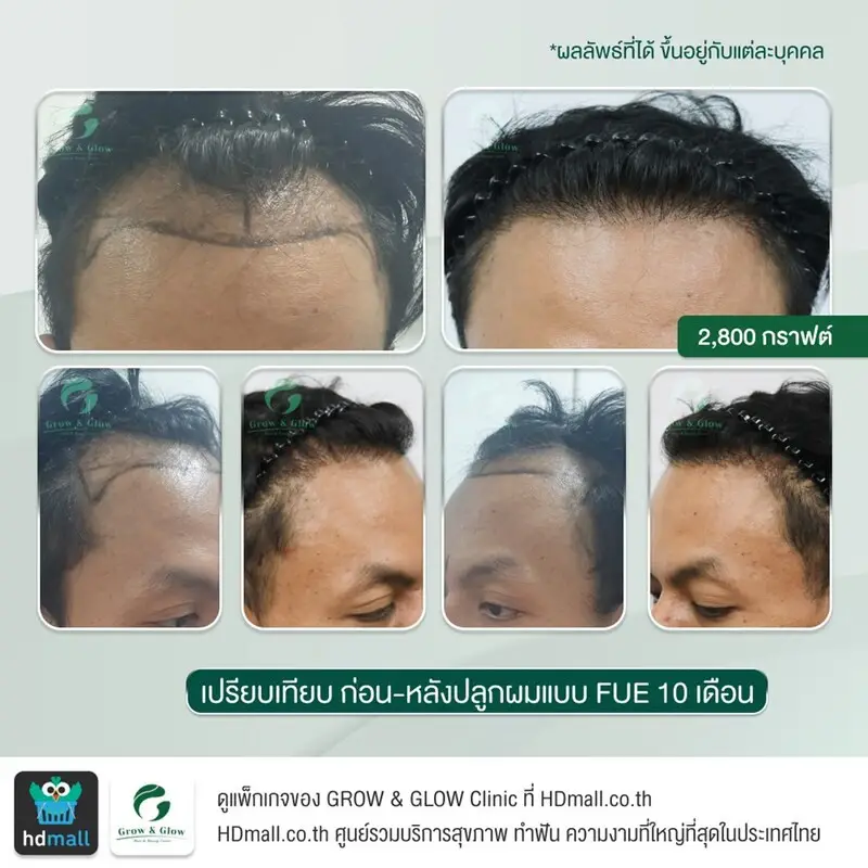 รวมรูปรีวิว ปลูกผม FUE ที่ GROW & GLOW Clinic