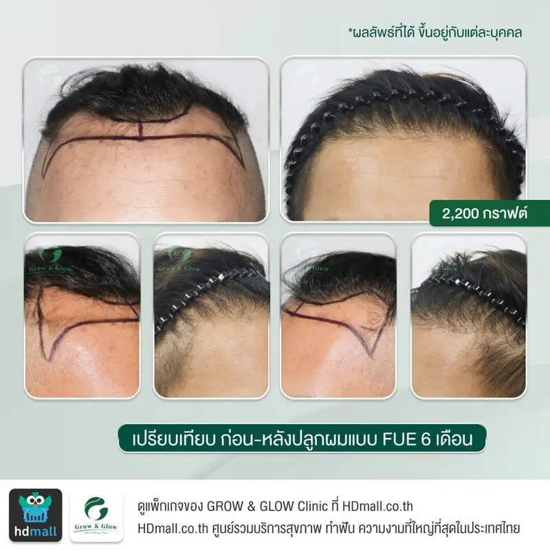 รวมรูปรีวิว ปลูกผม FUE ที่ GROW & GLOW Clinic