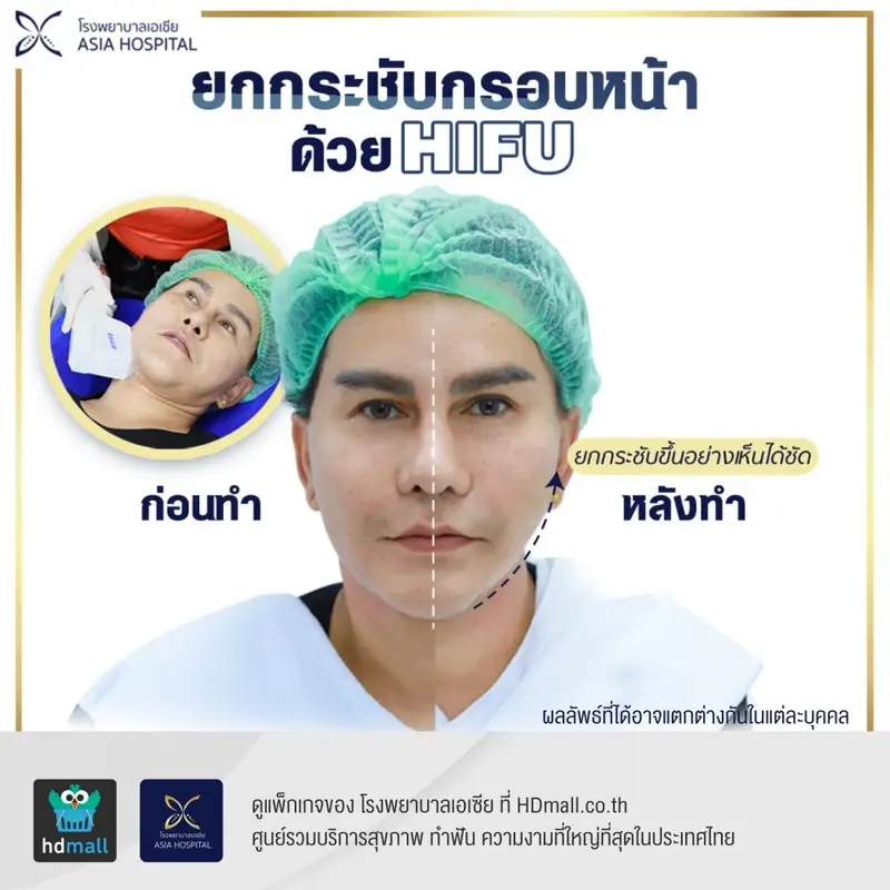รีวิว ทำ HIFU (ไฮฟู่) กระชับกรอบหน้า ที่ โรงพยาบาลเอเชีย