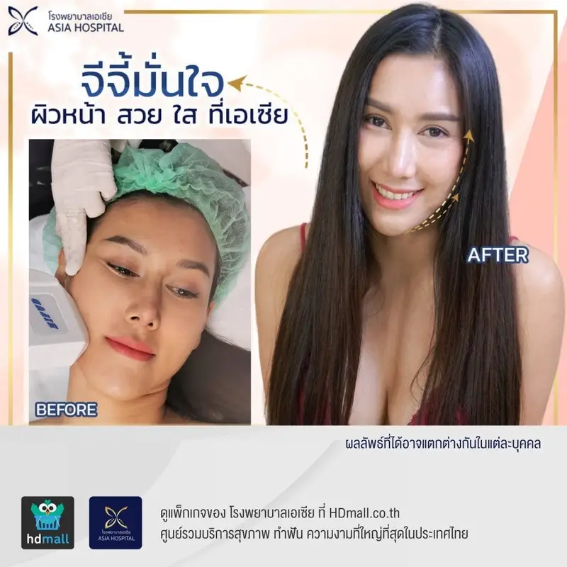 รีวิว ทำ HIFU (ไฮฟู่) กระชับกรอบหน้า ที่ โรงพยาบาลเอเชีย