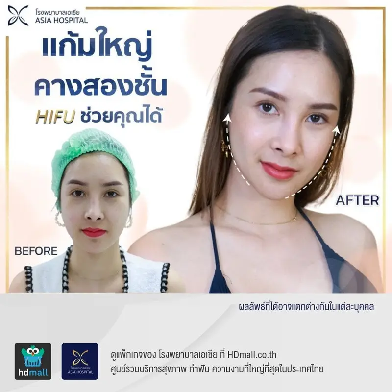 รีวิว ทำ HIFU (ไฮฟู่) กระชับกรอบหน้า ที่ โรงพยาบาลเอเชีย