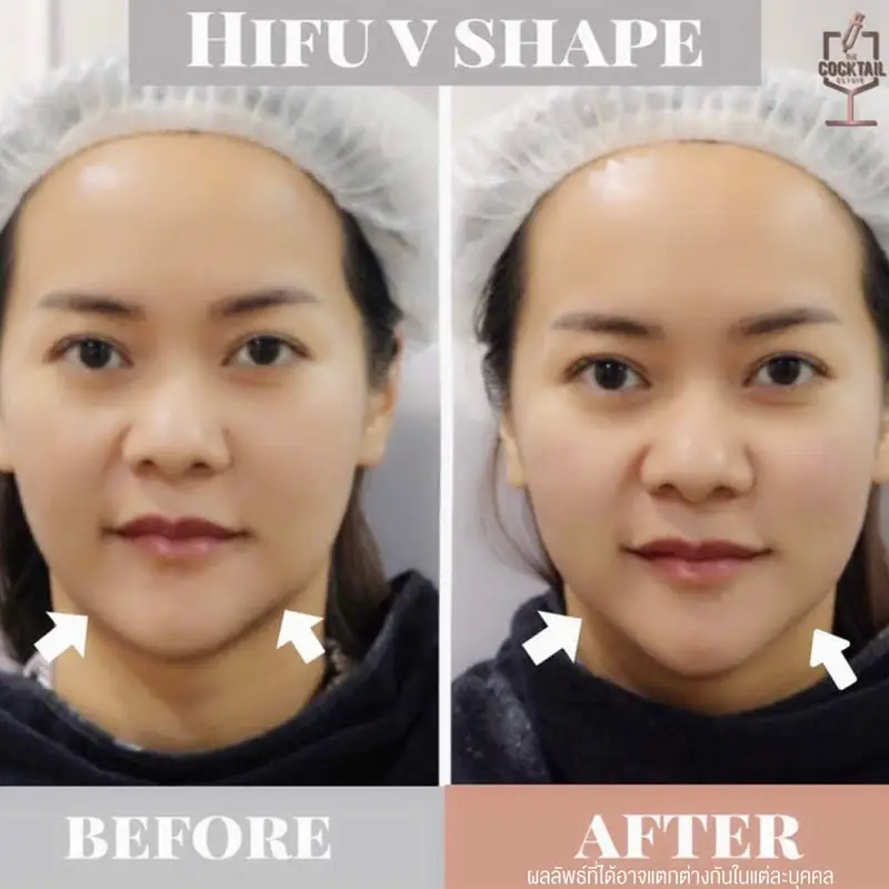 รีวิว ทำ HIFU ยกกระชับหน้า ที่ The Cocktail Clinic
