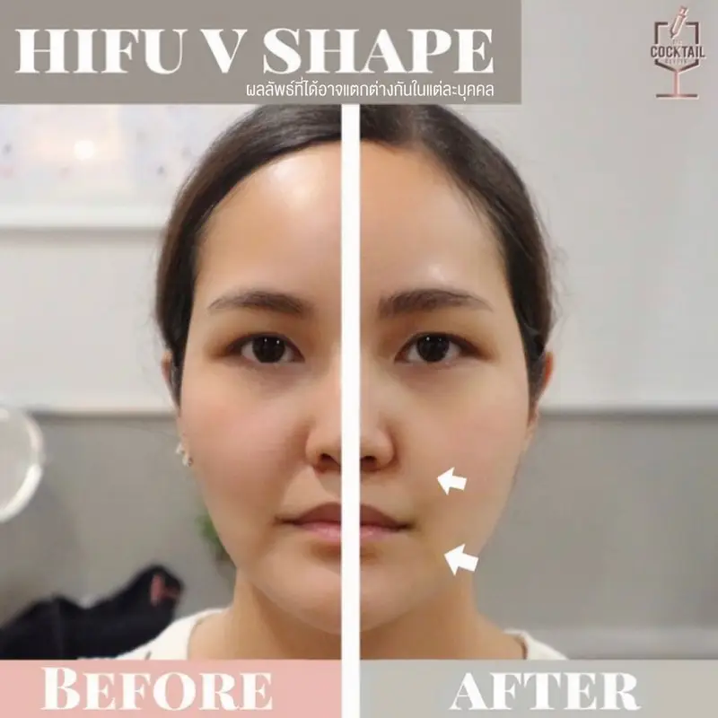รีวิว ทำ HIFU ยกกระชับหน้า ที่ The Cocktail Clinic