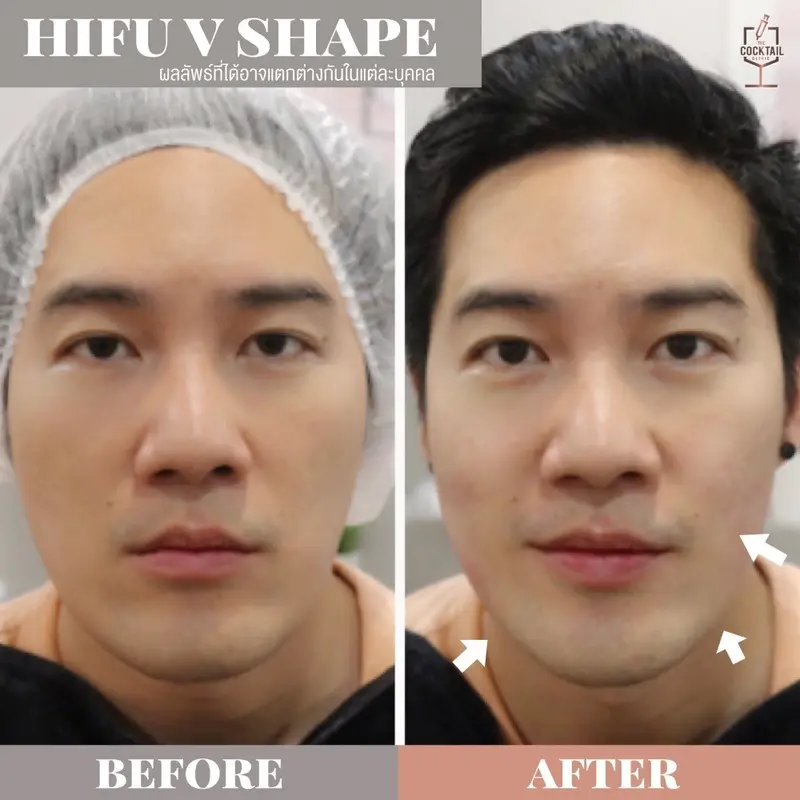 รีวิว ทำ HIFU ยกกระชับหน้า ที่ The Cocktail Clinic