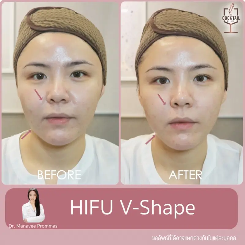 รีวิว ทำ HIFU ยกกระชับหน้า ที่ The Cocktail Clinic
