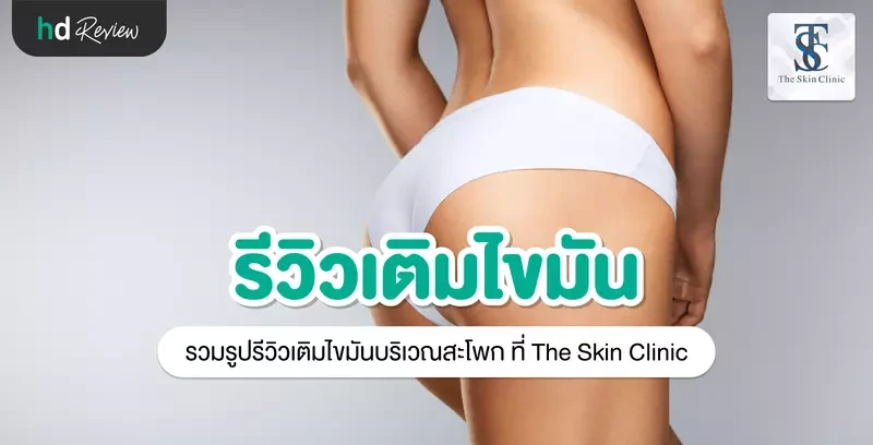 รีวิว เติมไขมันบริเวณสะโพก ที่ The Skin Clinic