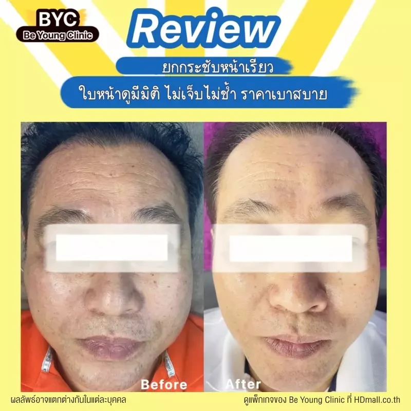รีวิว ยกกระชับใบหน้า ด้วยเครื่อง Hydra Dermabrasion ที่ Be Young Clinic