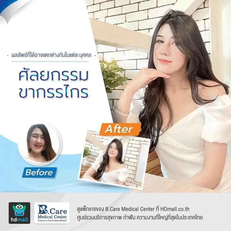 รีวิว ศัลยกรรมขากรรไกร ที่ โรงพยาบาล บี.แคร์ เมดิคอลเซ็นเตอร์ (B.Care Medical Center)