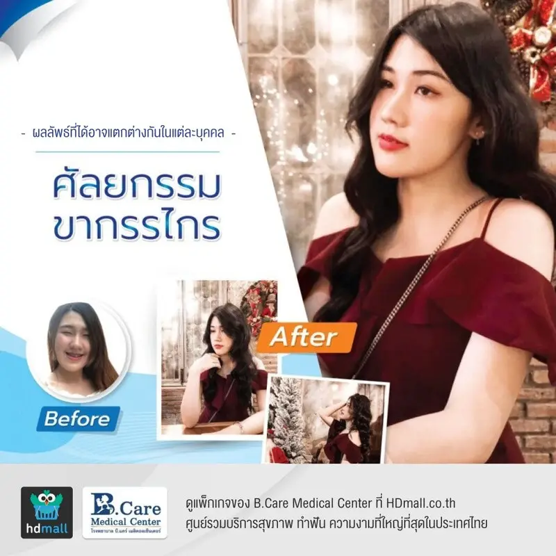 รีวิว ศัลยกรรมขากรรไกร ที่ โรงพยาบาล บี.แคร์ เมดิคอลเซ็นเตอร์ (B.Care Medical Center)