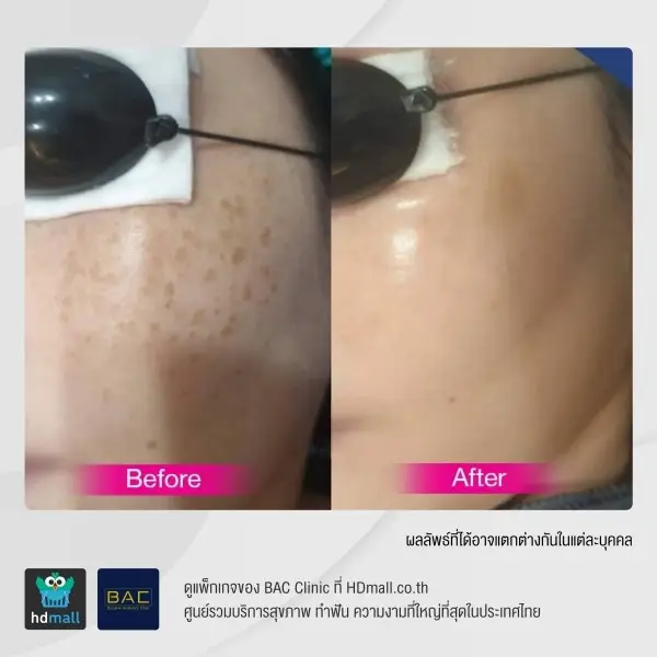 รีวิว รักษาฝ้ากระ ด้วย Picosecond ที่ BAC Clinic