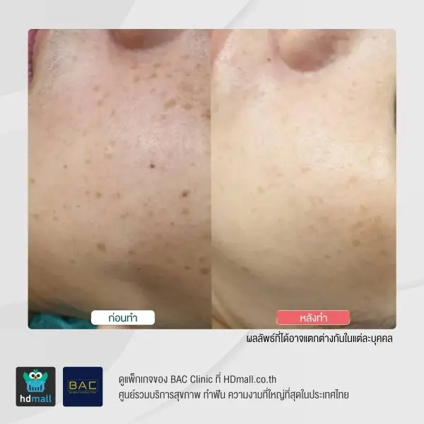 รีวิว รักษาฝ้ากระ ด้วย Picosecond ที่ BAC Clinic