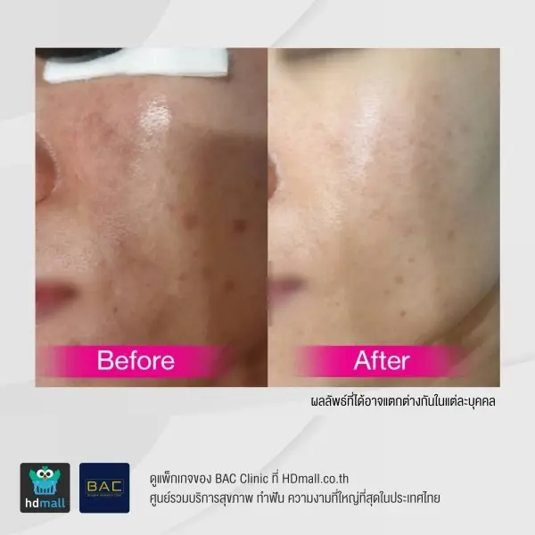 รีวิว รักษาฝ้ากระ ด้วย Picosecond ที่ BAC Clinic