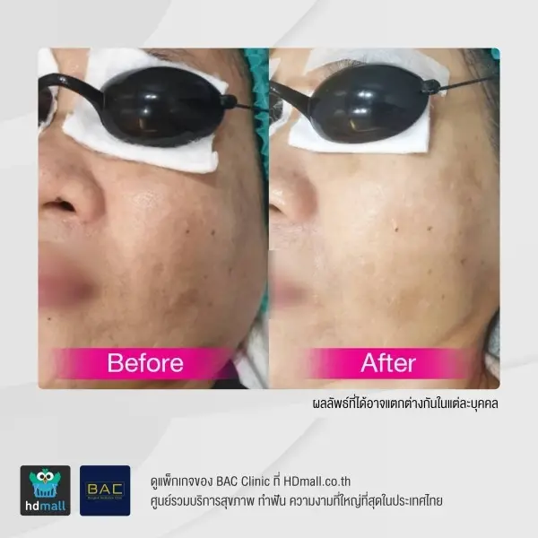 รีวิว รักษาฝ้ากระ ด้วย Picosecond ที่ BAC Clinic