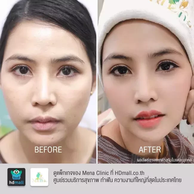 รีวิว ฉีดฟิลเลอร์ปาก ที่ Mena Clinic