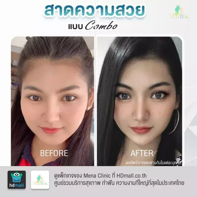 รีวิว ฉีดฟิลเลอร์ปาก ที่ Mena Clinic