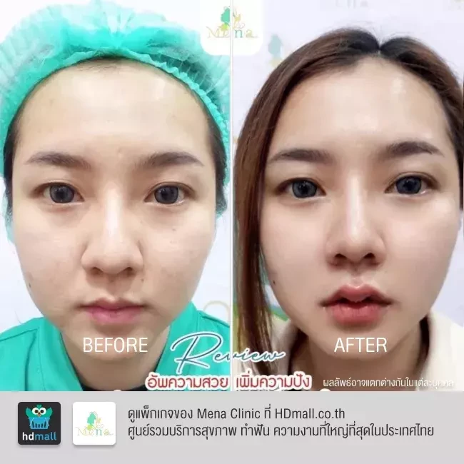 รีวิว ฉีดฟิลเลอร์ปาก ที่ Mena Clinic