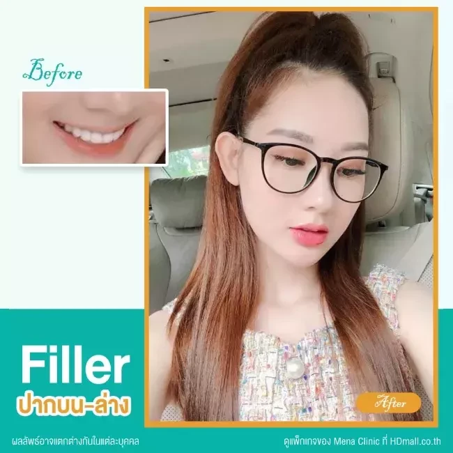 รีวิว ฉีดฟิลเลอร์ปาก ที่ Mena Clinic