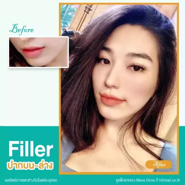 รีวิว ฉีดฟิลเลอร์ปาก ที่ Mena Clinic