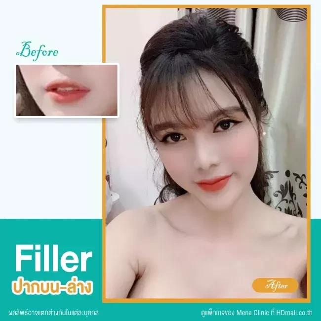 รีวิว ฉีดฟิลเลอร์ปาก ที่ Mena Clinic