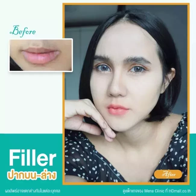 รีวิว ฉีดฟิลเลอร์ปาก ที่ Mena Clinic