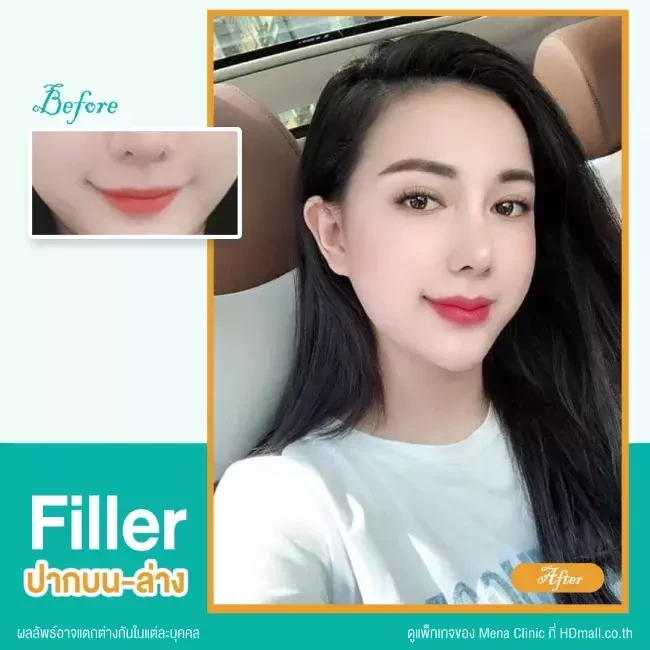 รีวิว ฉีดฟิลเลอร์ปาก ที่ Mena Clinic