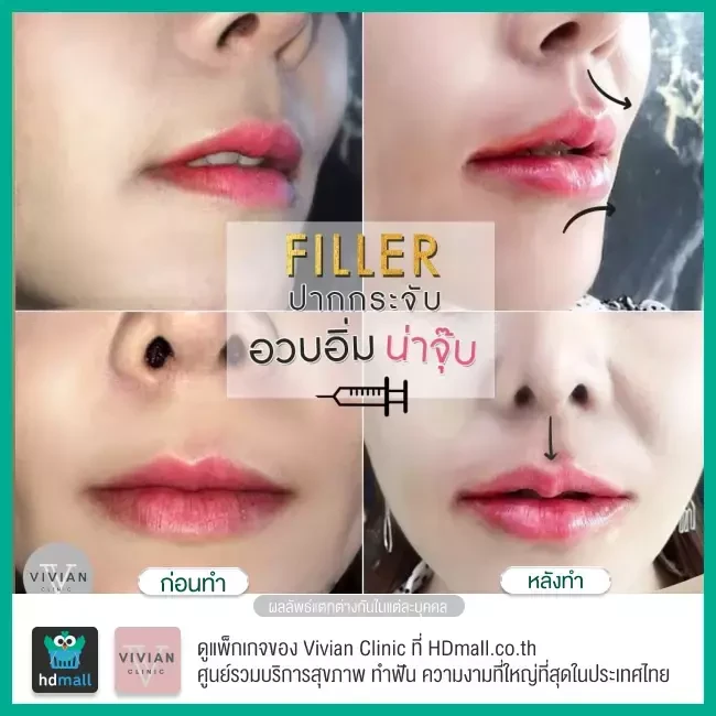 Before After รีวิว ฉีดฟิลเลอร์ปาก ที่ Vivian Clinic