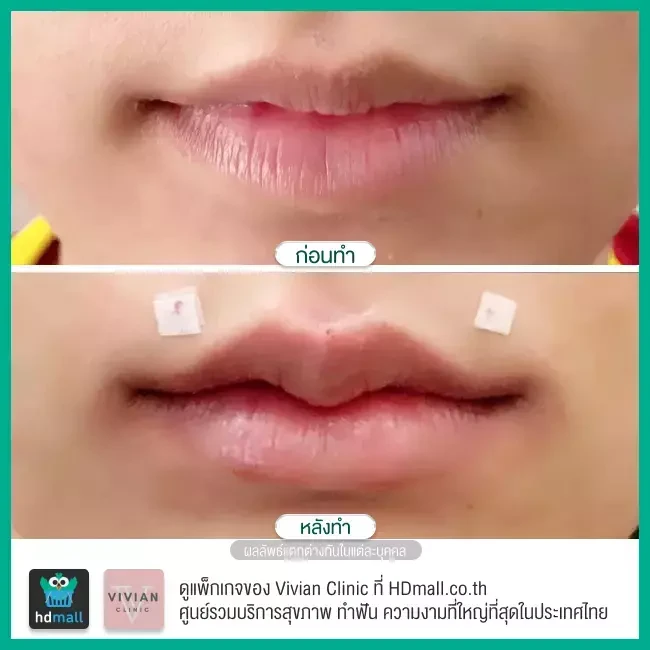 Before After รีวิว ฉีดฟิลเลอร์ปาก ที่ Vivian Clinic
