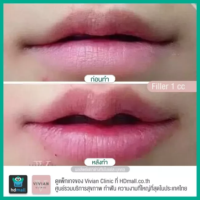 Before After รีวิว ฉีดฟิลเลอร์ปาก ที่ Vivian Clinic