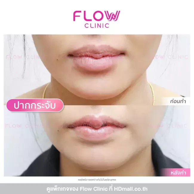รีวิว ผ่าตัดทำปากกระจับ ที่ Flow Clinic